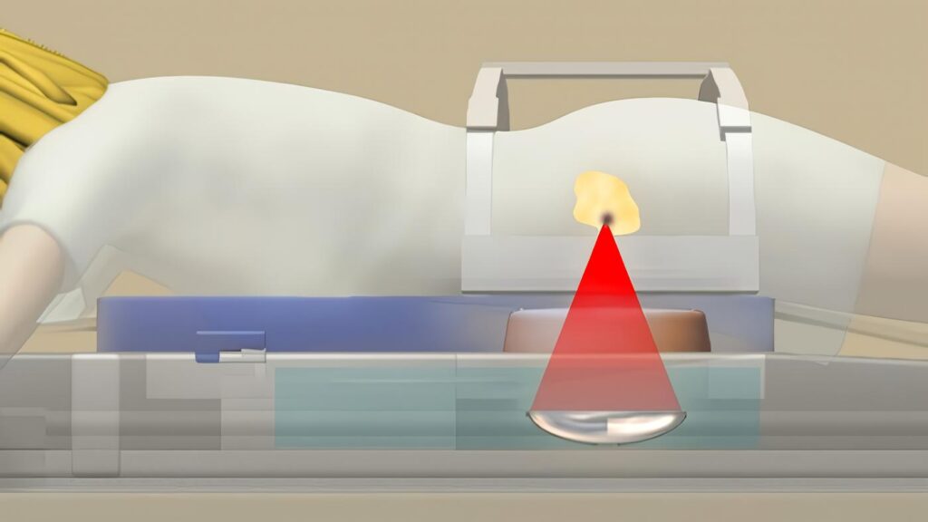 El Ultrasonido Enfocado alivia los Síntomas de los Fibromas