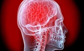 Accidente Cerebrovascular