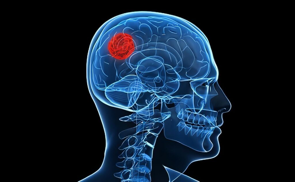 Las alergias protegerían contra cierto tipo de cáncer cerebral