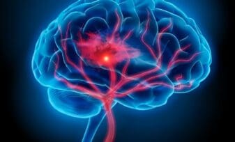 Anticoagulante con Sangrado Cerebral