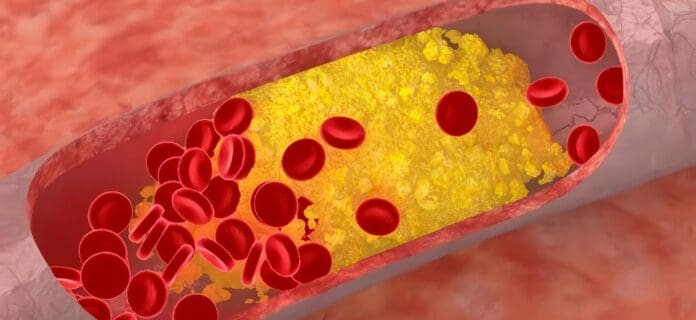 Azúcares en el Hígado puede limpiar Grasas de la Sangre