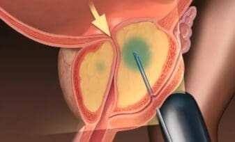 Cambio en la biopsia del cáncer de próstata