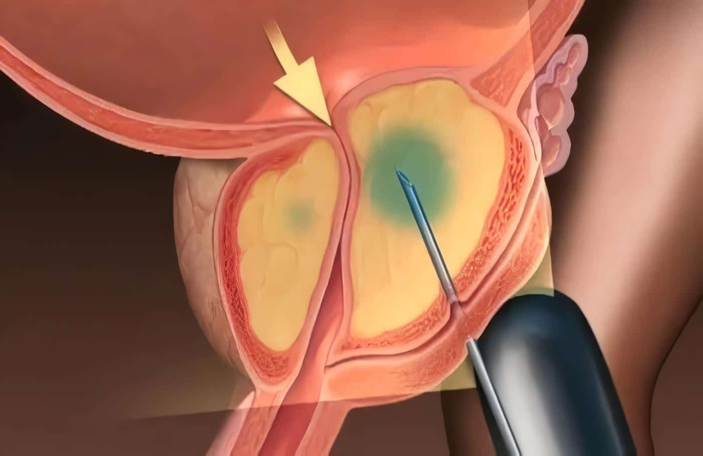 Cambio en la biopsia del cáncer de próstata