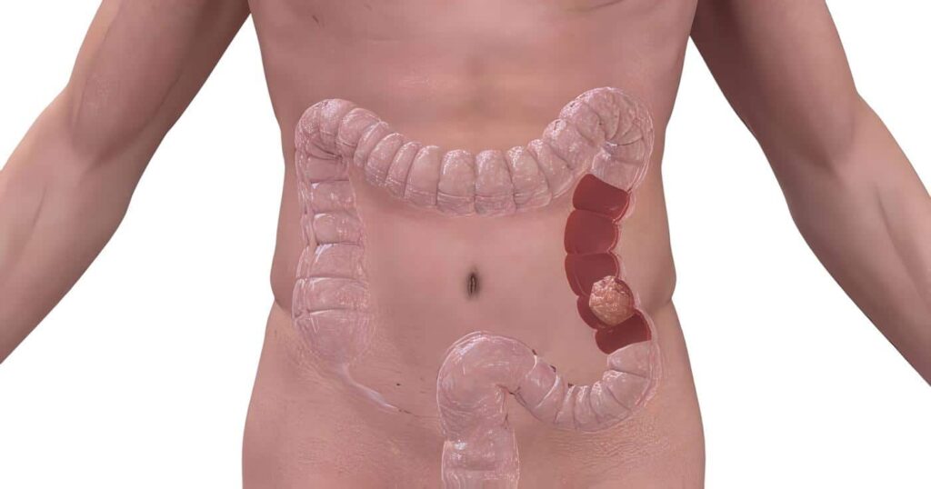 Cambios Químicos y Cáncer de Colon