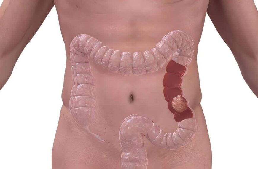 Cambios Químicos y Cáncer de Colon