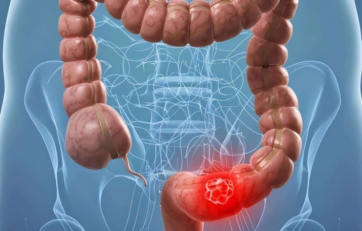 Terapia con Anticuerpos podría evitar el Cáncer Colorrectal