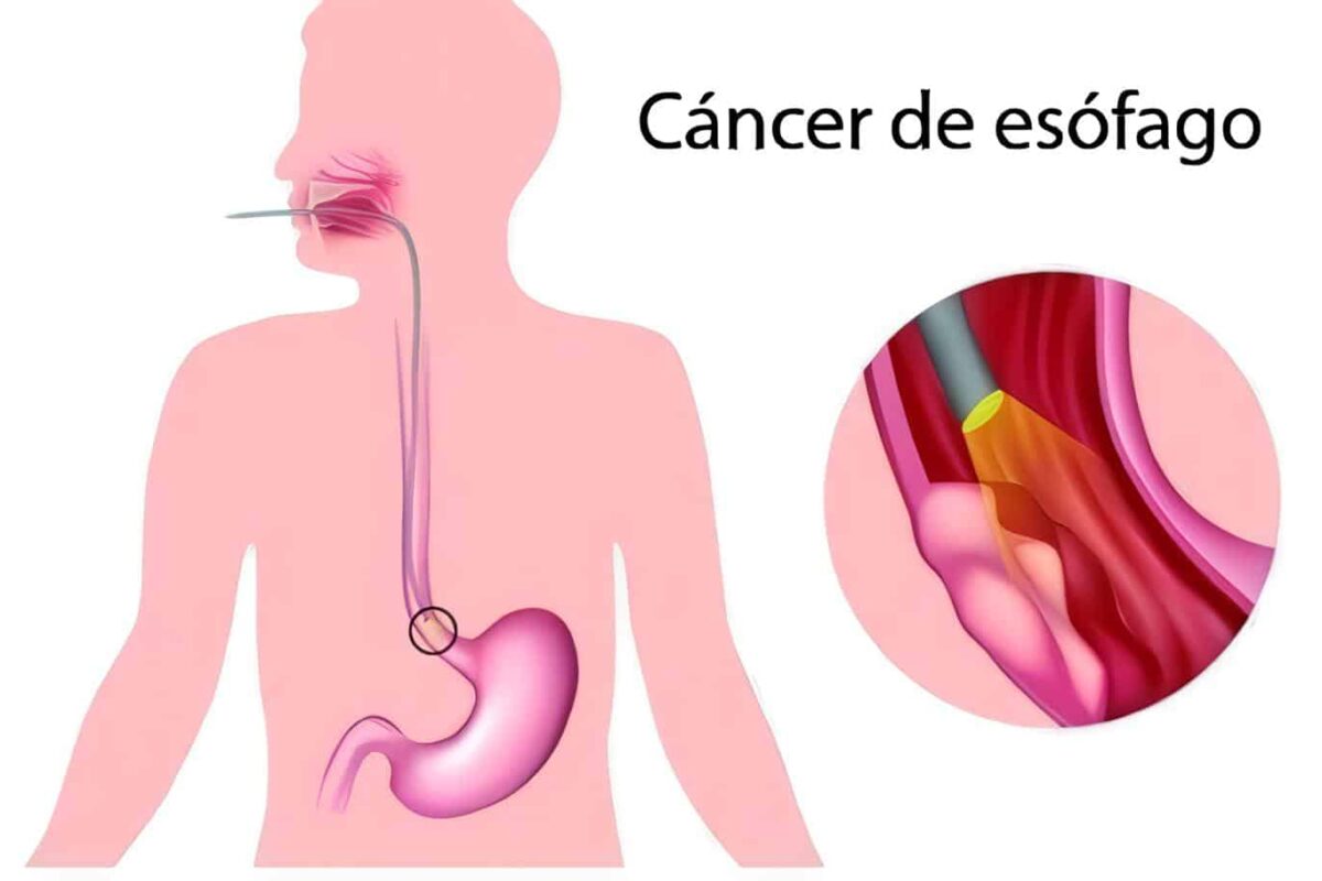 Marcadores Genéticos del Cáncer de Esófago