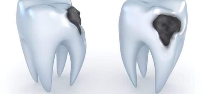 caries-dental y salud oral