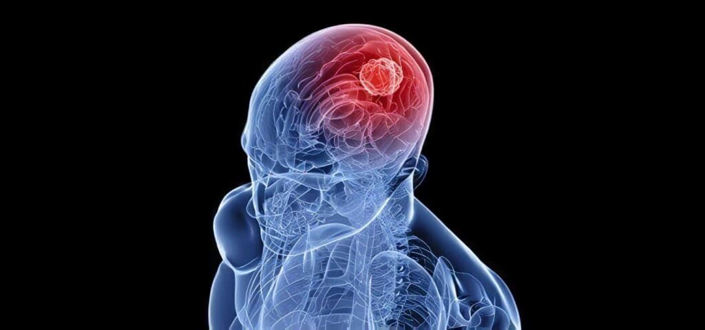 Prueba Sanguínea para detectar Tumores Cerebrales