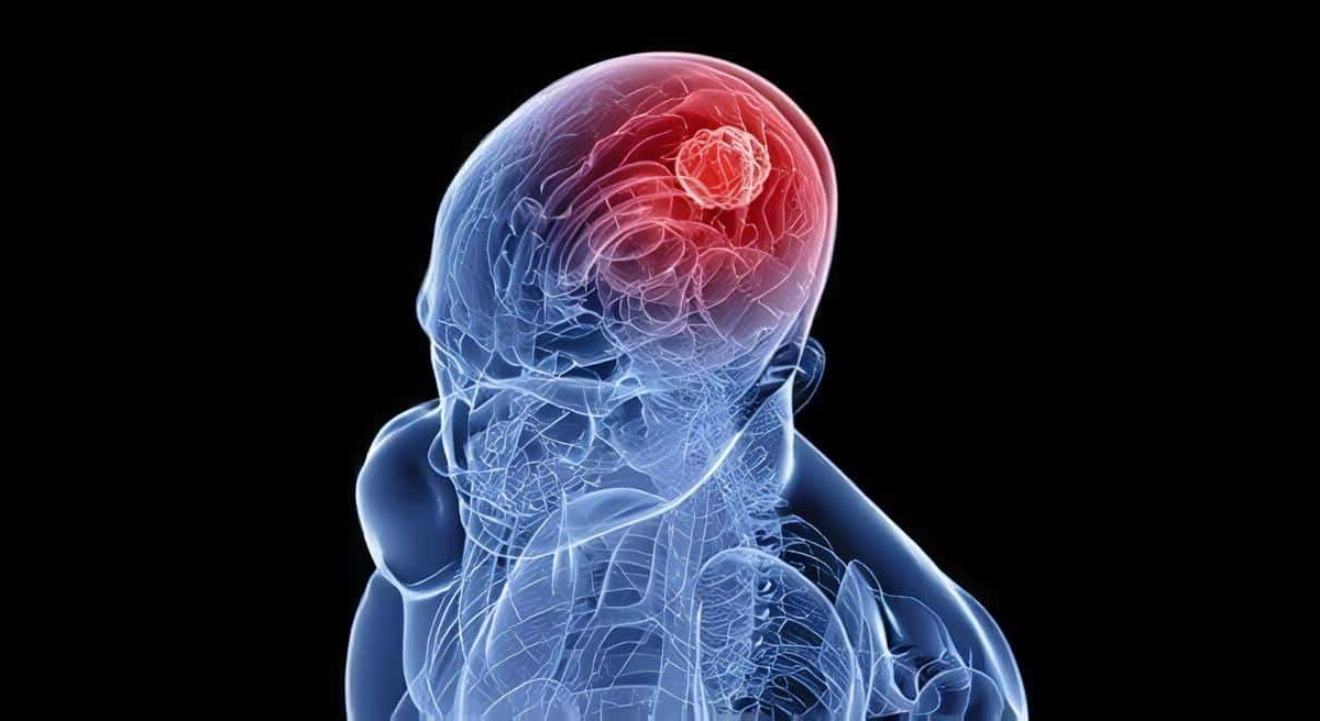 Prueba Sanguínea para detectar Tumores Cerebrales