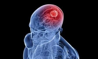 Prueba Sanguínea para detectar Tumores Cerebrales