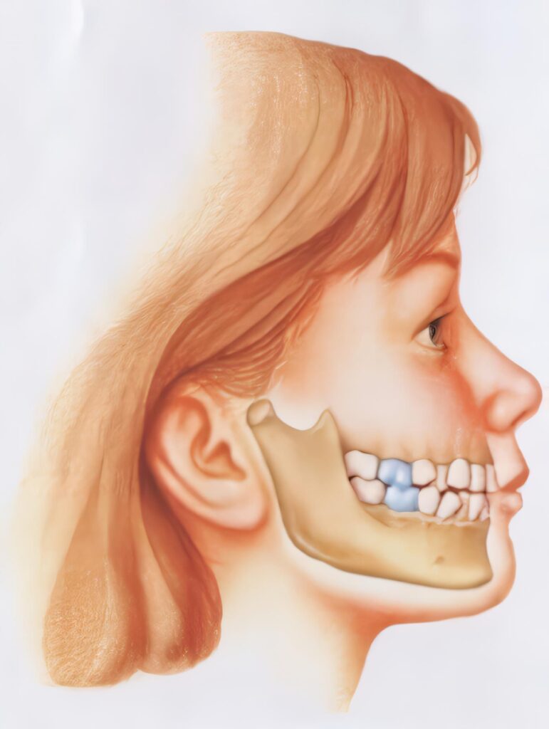 El Crecimiento Facial y Las Posibilidades Quirúrgicas