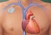 Un medicamento y un marcapasos combaten la arritmia cardiaca