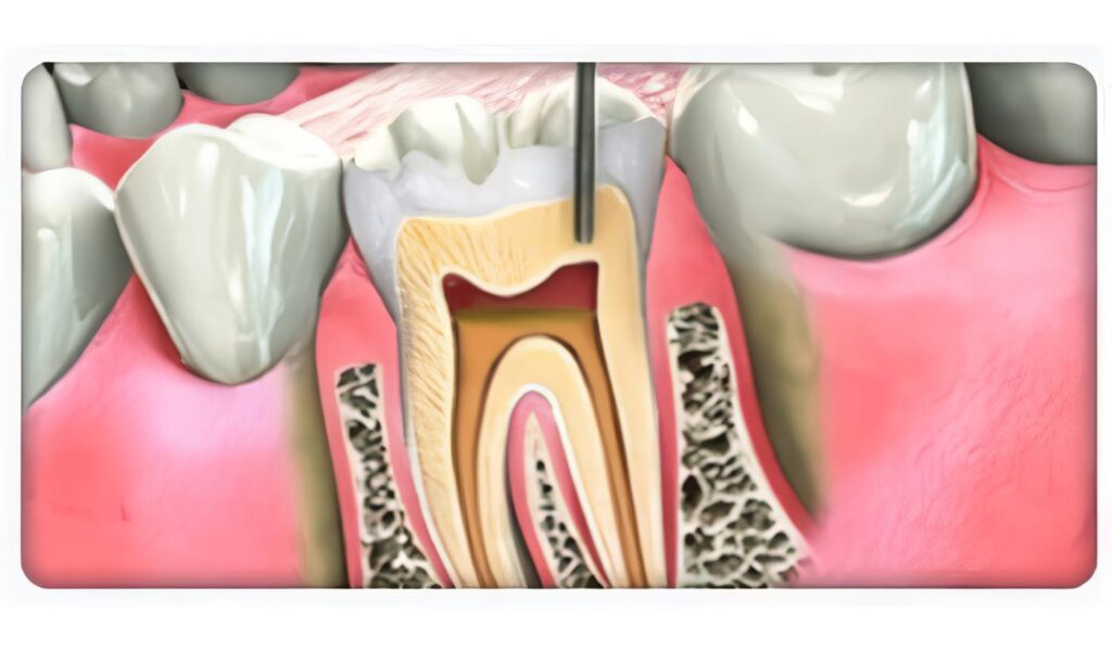 Pacientes con periodontitis