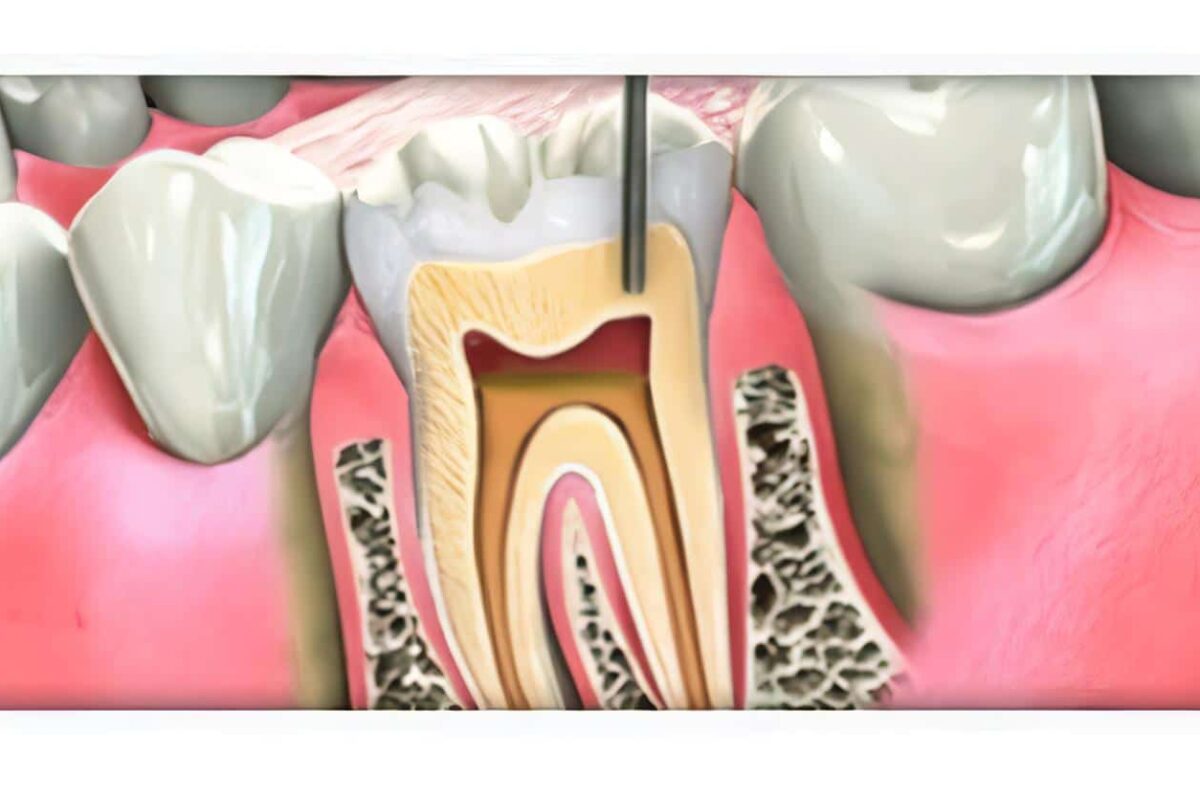 Pacientes con periodontitis
