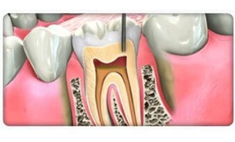 Pacientes con periodontitis
