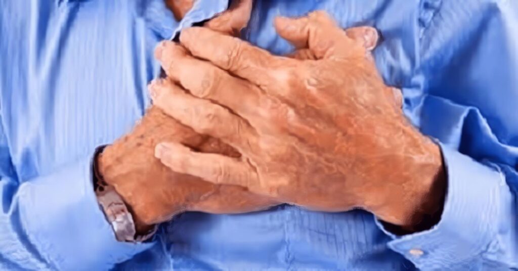 Psoriasis es un Factor de Riesgo Independiente de IAM