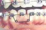 Resorte para Abrir y Mantener Espacios en ortodoncia 4