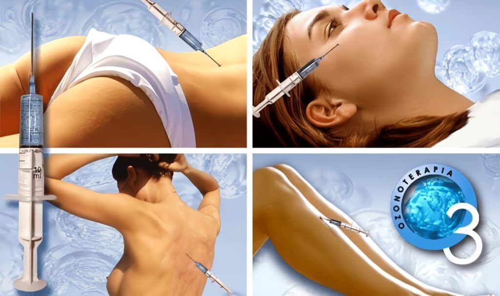 Ozono Inyectado, Nuevo Tratamiento para la Fibromialgia