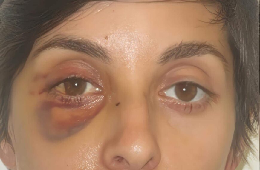 Trauma Orbital con Penetración de Cuerpo Extraño en el Maxilar Superior