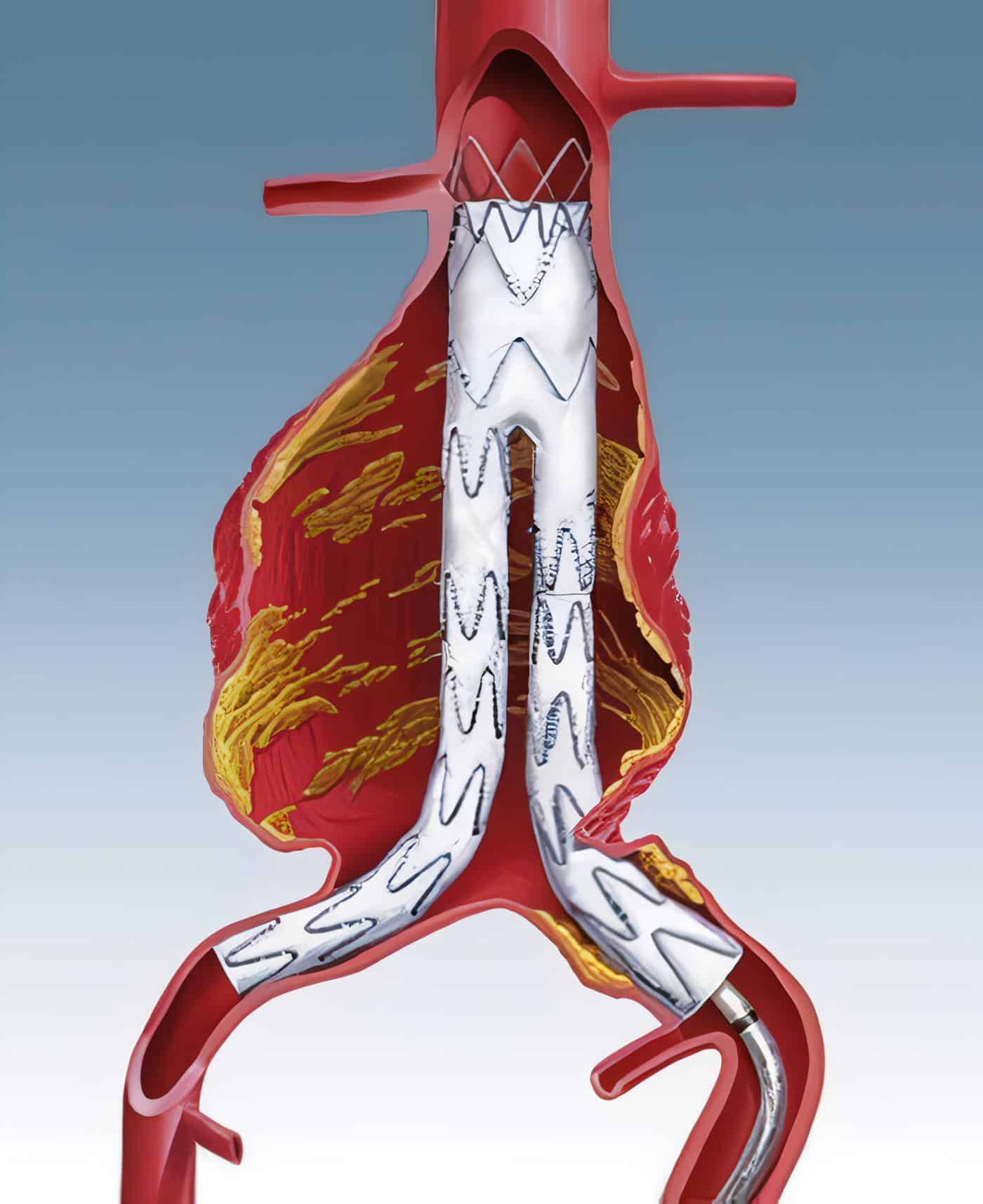 Aneurismas Aórticos Endovascular