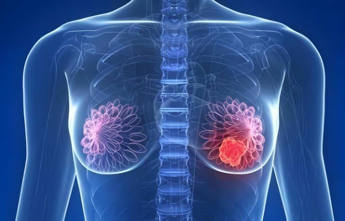 Cáncer Invasivo de Mama
