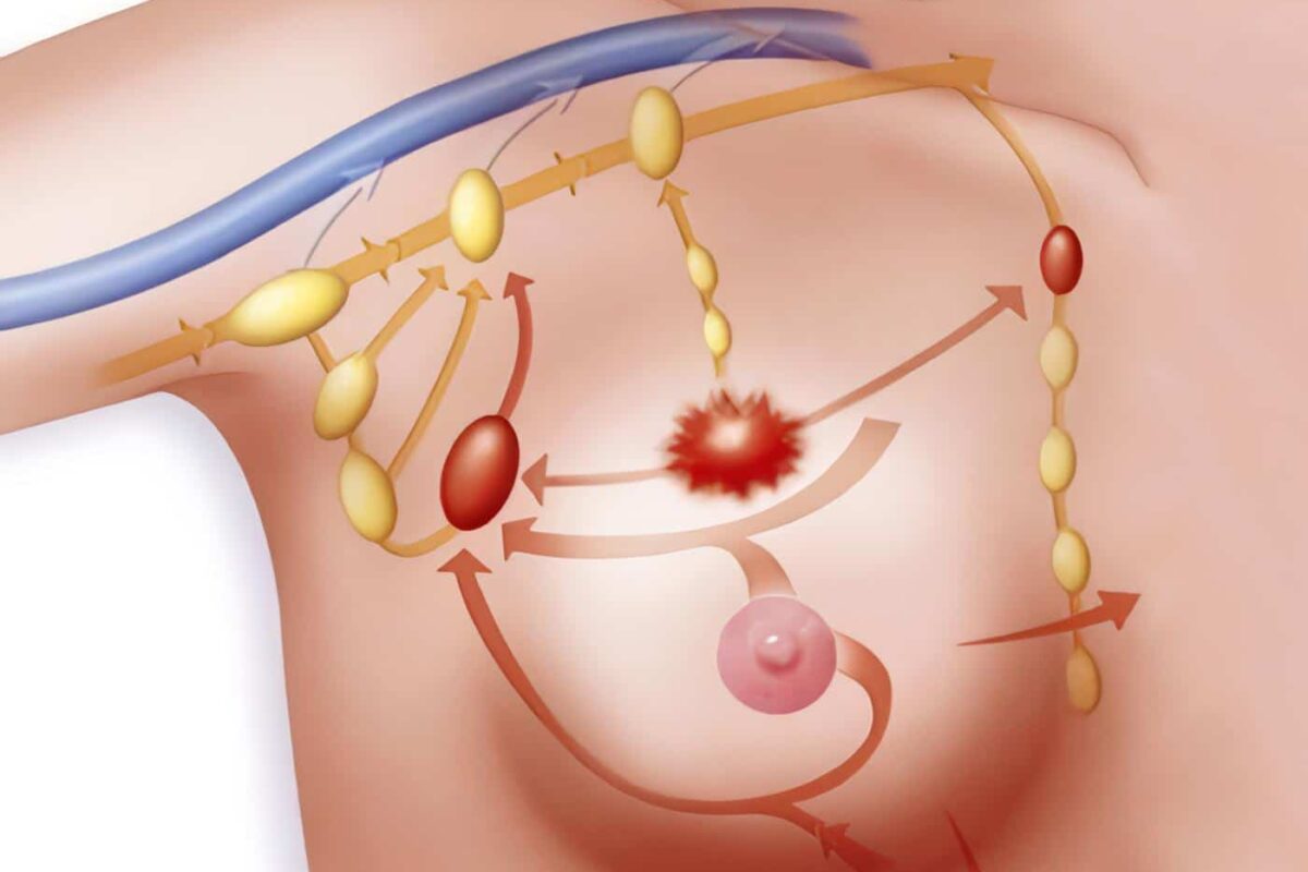 Estudio del Cáncer de Mama