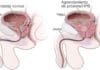 Evaluación del Cáncer de Próstata