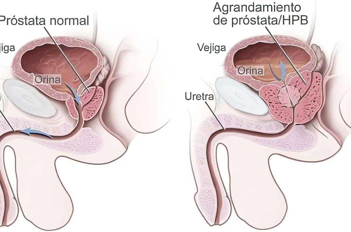 Evaluación del Cáncer de Próstata