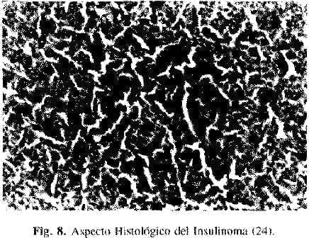Fig. 8. Aspecto Histológico del Insulinoma (24).