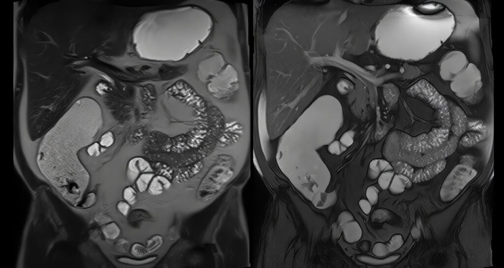 Insulinomas, Casuística
