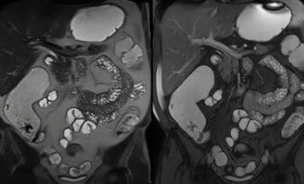 Insulinomas, Casuística