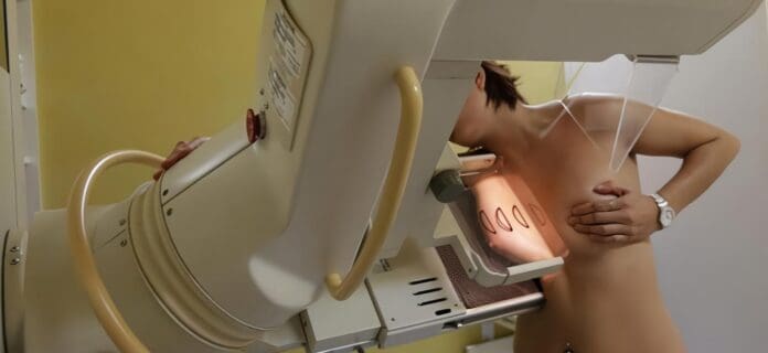 Mamografías Conllevan Más Mastectomías