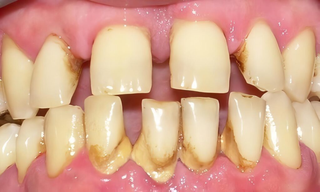 Marihuana y Enfermedad Periodontal