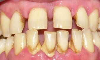 Marihuana y Enfermedad Periodontal