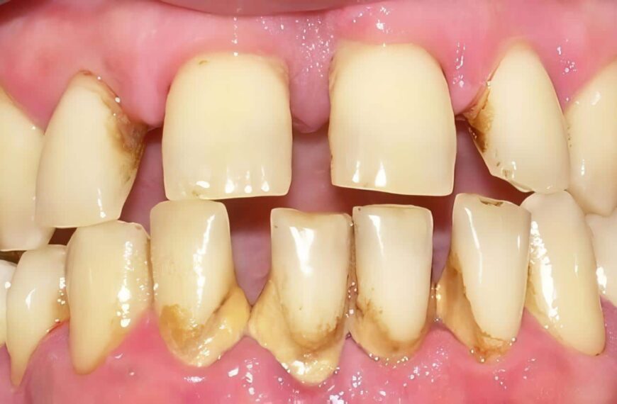 Marihuana y Enfermedad Periodontal