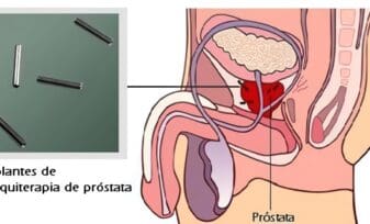 Debate sobre un Medicamento para la Próstata