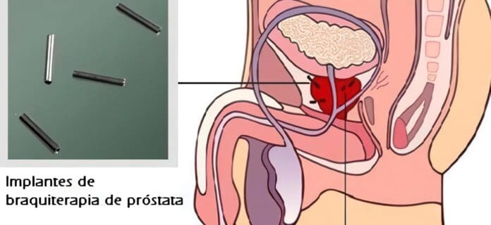 Debate sobre un Medicamento para la Próstata