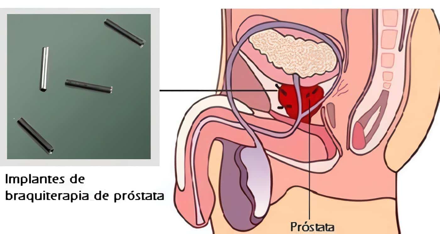 Debate sobre un Medicamento para la Próstata
