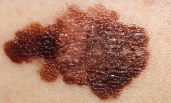 Riesgo de Melanoma en Pacientes con Parkinson