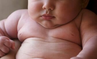 Obesidad Infantil y riesgo de ERGE