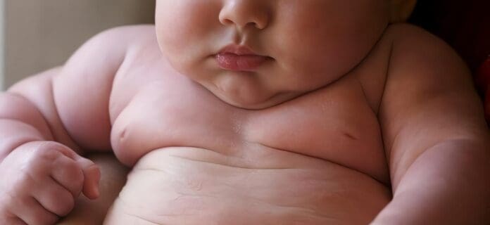 Obesidad Infantil y riesgo de ERGE