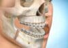 Medicamento para la Osteoporosis podría tratar la Pérdida Ósea en la Mandíbula