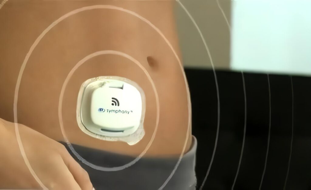 Sensor Implantable mide los Niveles de Glucemia