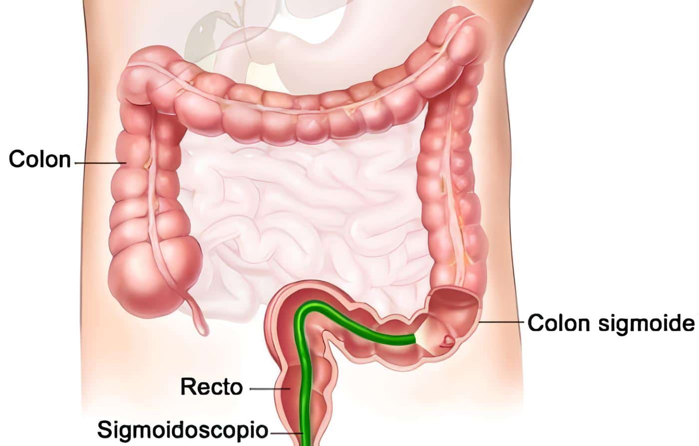 Sigmoidoscopia Incrementa las probabilidades de Supervivencia