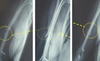 Una Manera de Soldar Fracturas más Rápidamente