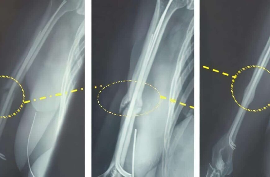 Una Manera de Soldar Fracturas más Rápidamente