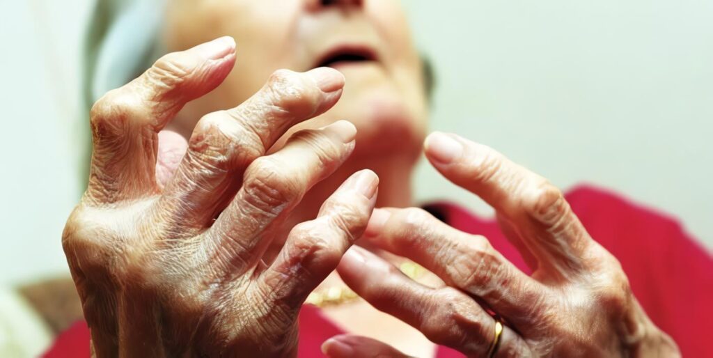Variaciones Genéticas Osteoartritis Grave