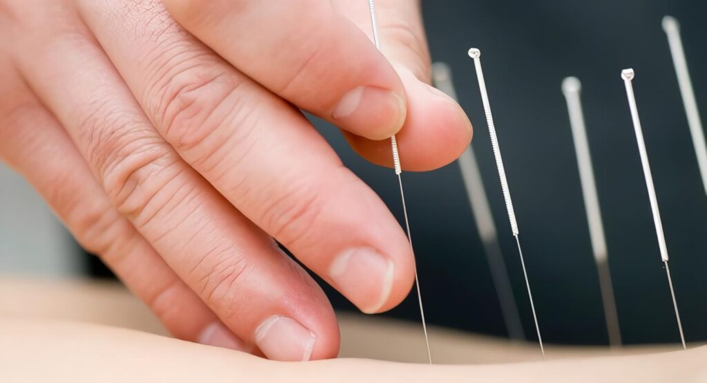 Acupuntura