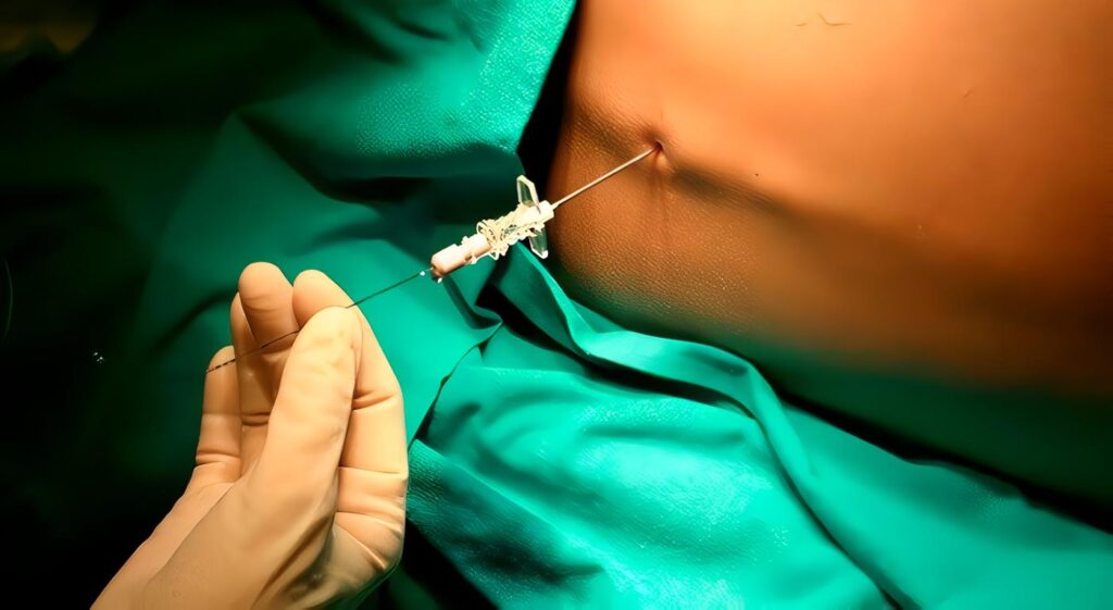 Analgesia en Trabajo de Parto